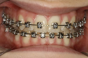 metal fixed braces appliances brackets appliance orthodontics